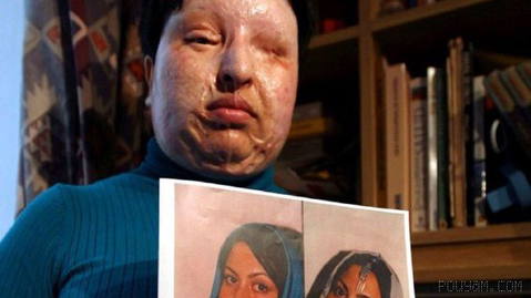 ⏺“Aminah Barami,” a student of electronics at Islamic Azad University in Eslamshahr, was subjected to an acid attack in 83 after rejecting her classmate’s marriage proposal…
