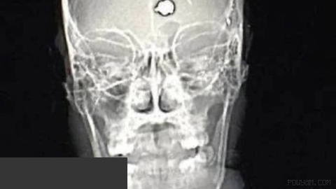⏺A man with severe obsessive-compulsive disorder tried to commit suicide by shooting himself in the head.